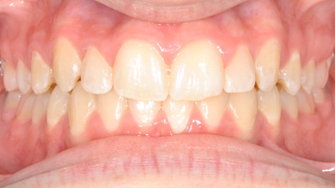 Close-up of front teeth with mild crowding